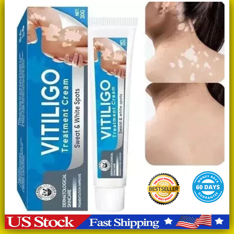 Vitiligo Treatment, Vitiligo Cream Improve Skin Pigmentation & Reduces White ... gallery