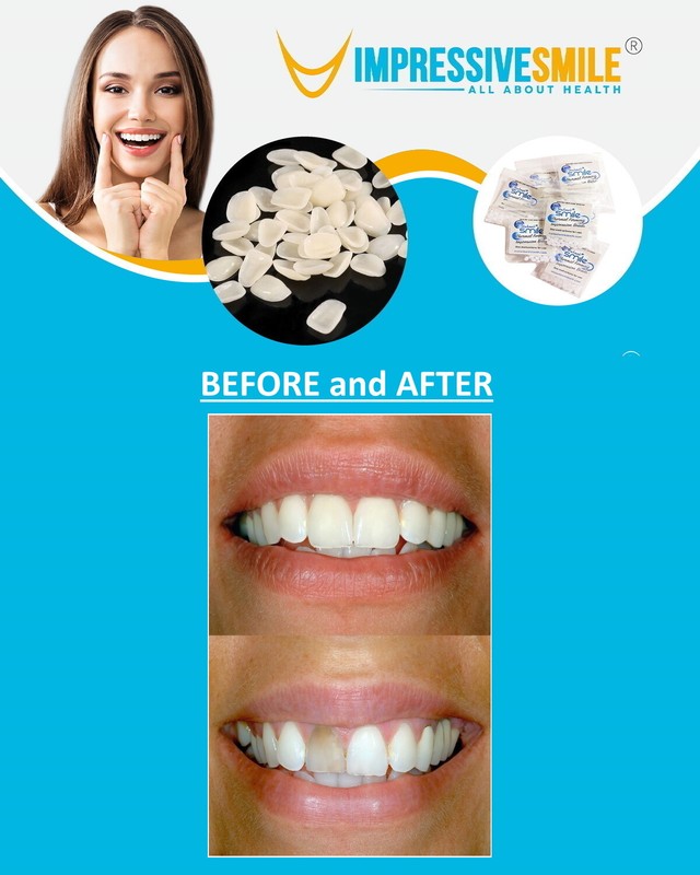 IMPRESSIVE ULTRA THIN TOOTH WHITENING VENEERS CHOOSE SHADE A-1, A-2 or A-3 gallery
