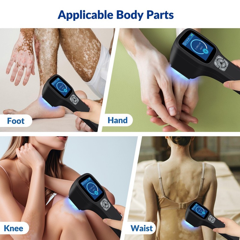 Home 308nm UVB Lamp Phototherapy Device Portable Rechargeable for Skin Treatment gallery