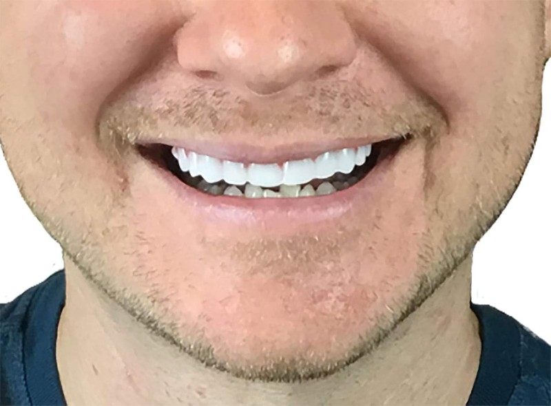 Custom Fit White Veneers - Easy Application Free USA Shipping gallery
