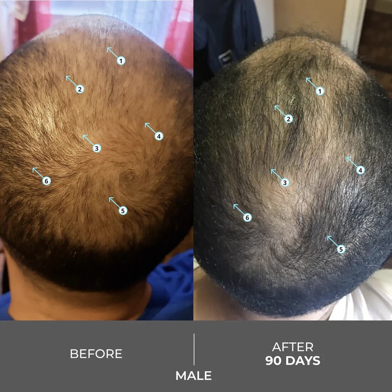 Revita Extra Strength Hair Density Shampoo for Hair Growth for Men and Women gallery