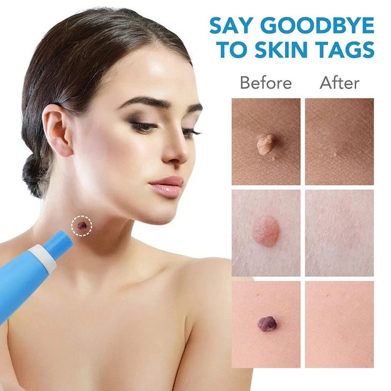 Auto Micro Skin Tag Remover Device Kit Safe Painless Removal 2-8 mm Band Tool gallery