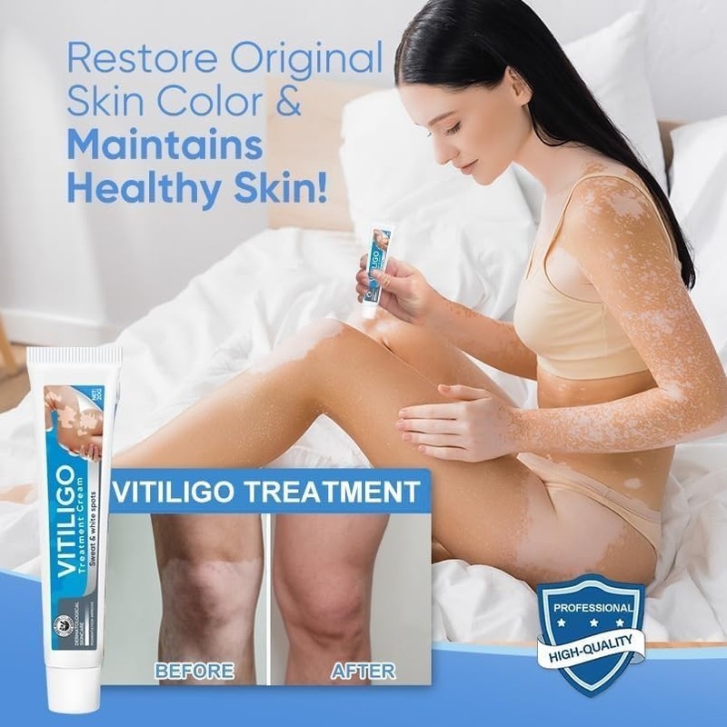 Vitiligo Treatment, Vitiligo Cream Improve Skin Pigmentation & Reduces White ... gallery