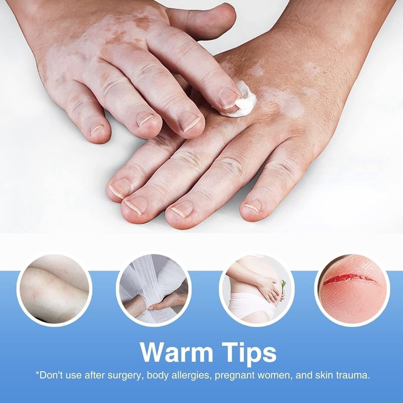 Vitiligo Treatment, Vitiligo Cream Improve Skin Pigmentation & Reduces White ... gallery