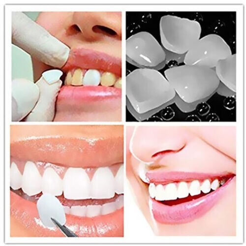 Dental Veneers Upper Lower Anterior Mixed Ultra-Thin Resin Teeth Whitening gallery