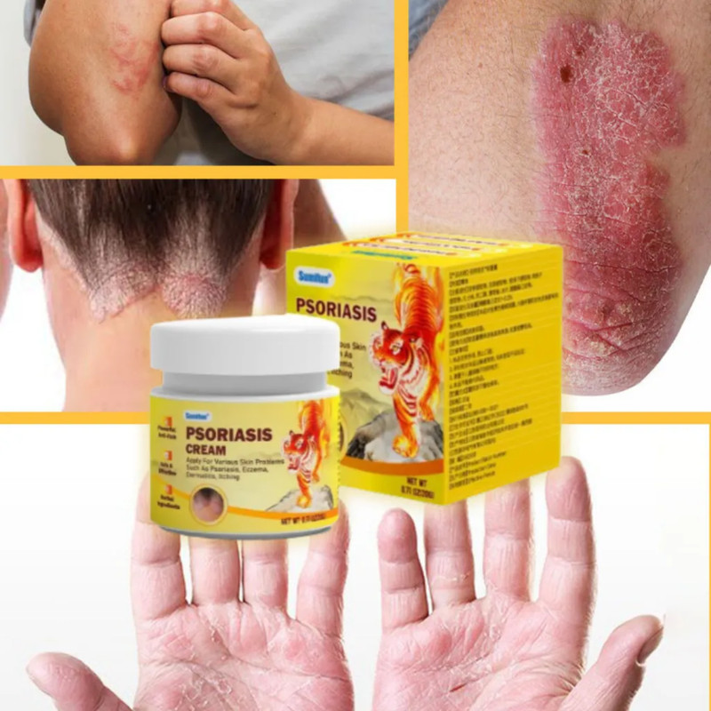 1pcs Psoriasis Cream 20gHerbal for Itchy &Irritated Skin (EXP DATE: 10/05/2027)