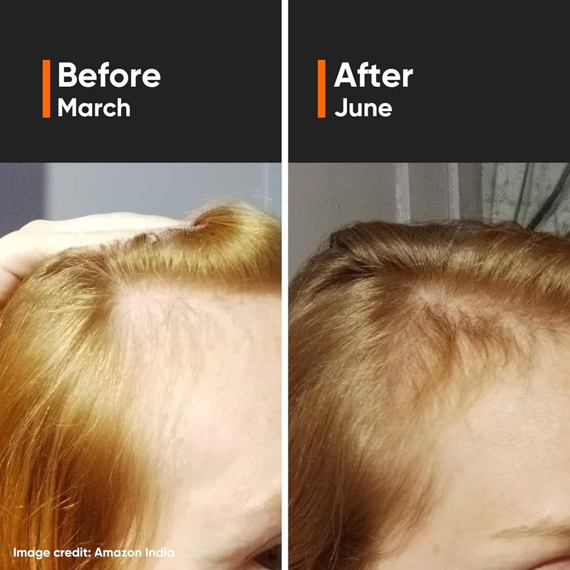 Hair Density Serum 18% | with Procapil, Capixyl, Redensyl, Anagain & Baicapil fo gallery