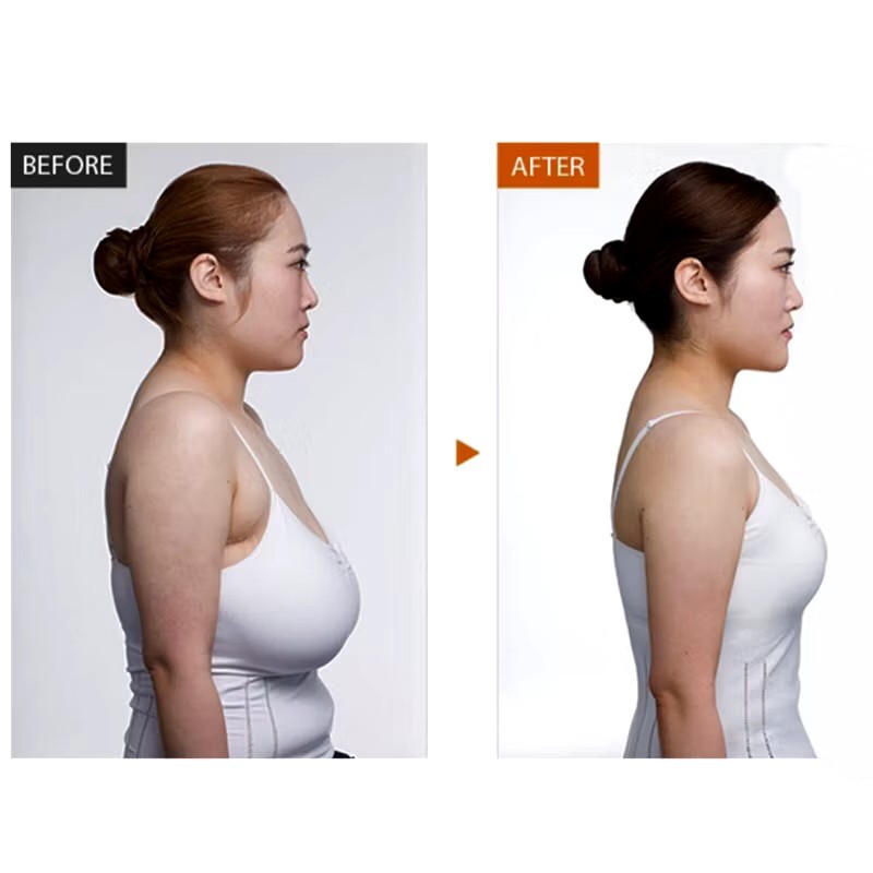 Breast Reduction Serum 10ML For Reducing Breast Size To Small, Firming & Lifting gallery