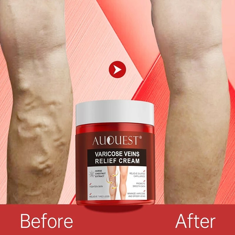 AUQUEST Varicose Veins Relief Cream Vasculitis Spider Vein Pain Relief Ointment