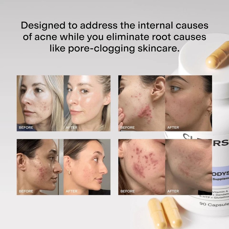 CLEARSTEM - MINDBODYSKIN Hormonal Acne Supplement 180 Count (Pack of 2) gallery