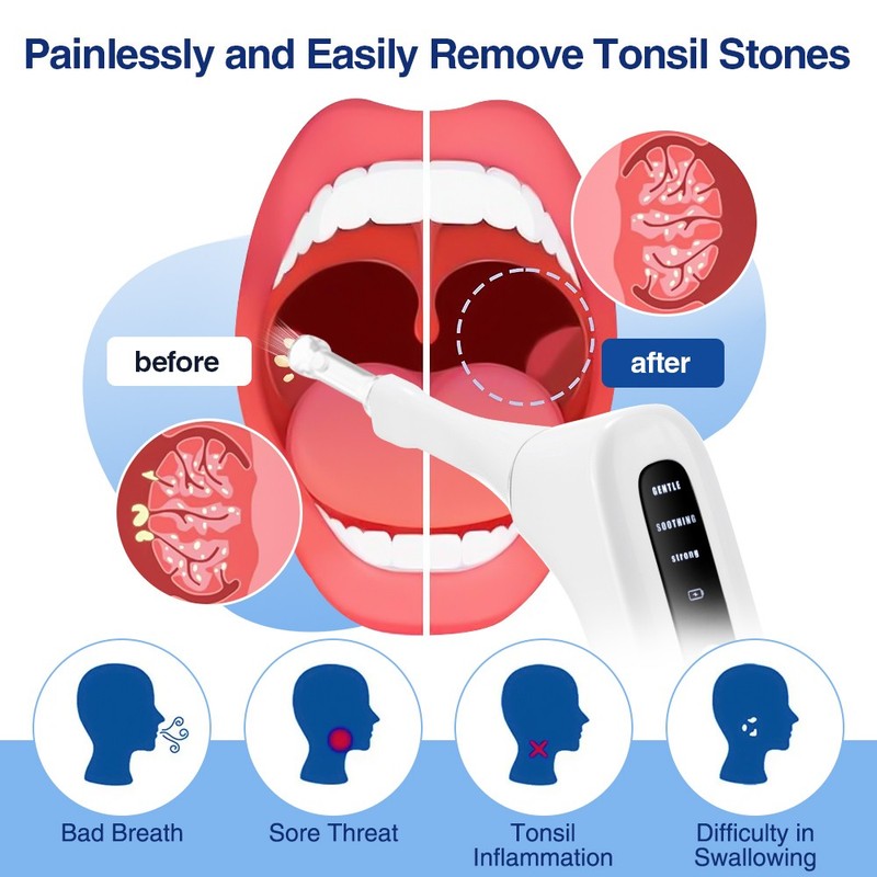 Tonsil Stone Vacuum Removal Kit with LED Light - Electronic Tonsil Stone Remover gallery