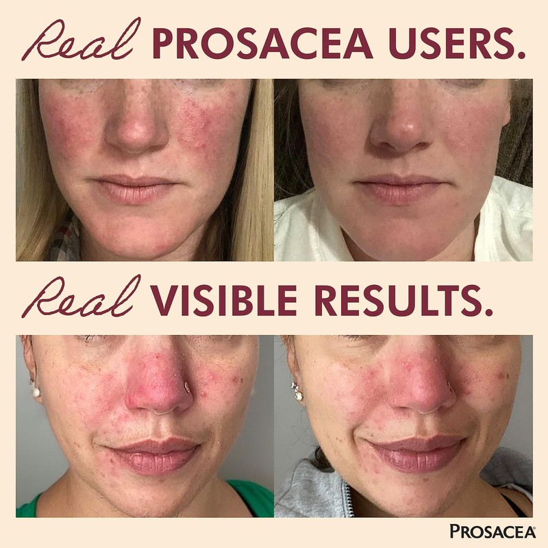 - Medicated Rosacea Treatment for Face - Heals Rosacea Symptoms of Redness, P... gallery