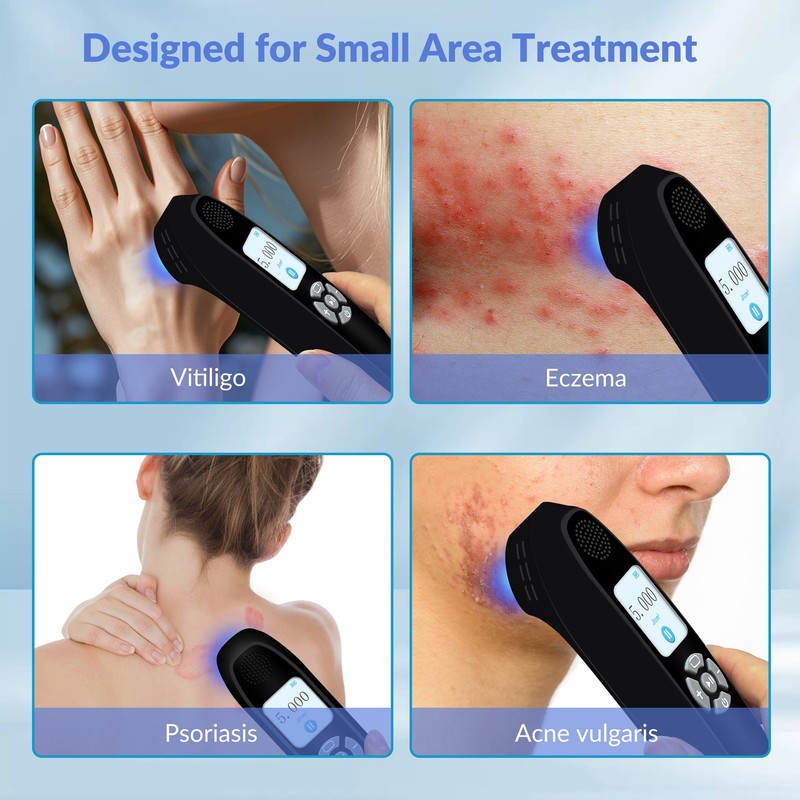 308nm UVB Light Therapy Device Face Hand Body Skin Treatment 9 Diodes 65mW/cm² gallery