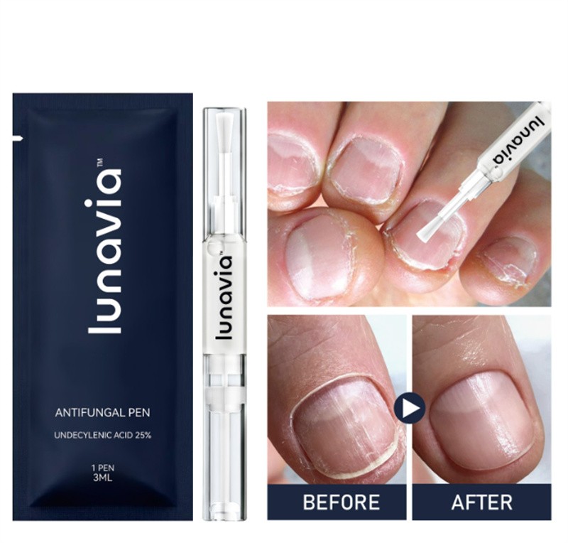 6 Pack Lunavia Antifungal Pen, 25% Undecylenic Acid – Toenail Fungus Treatment gallery