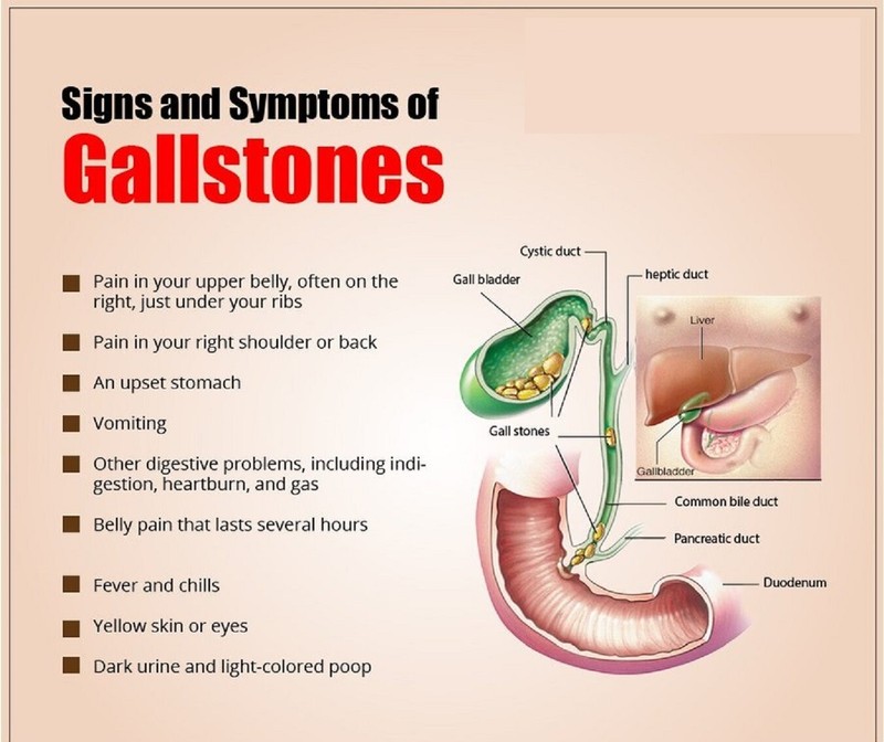 STONE BREAKER - BEST HERBAL FORMULA - GALLBLADDER&STONES - GALLSTONES&BREAKER gallery
