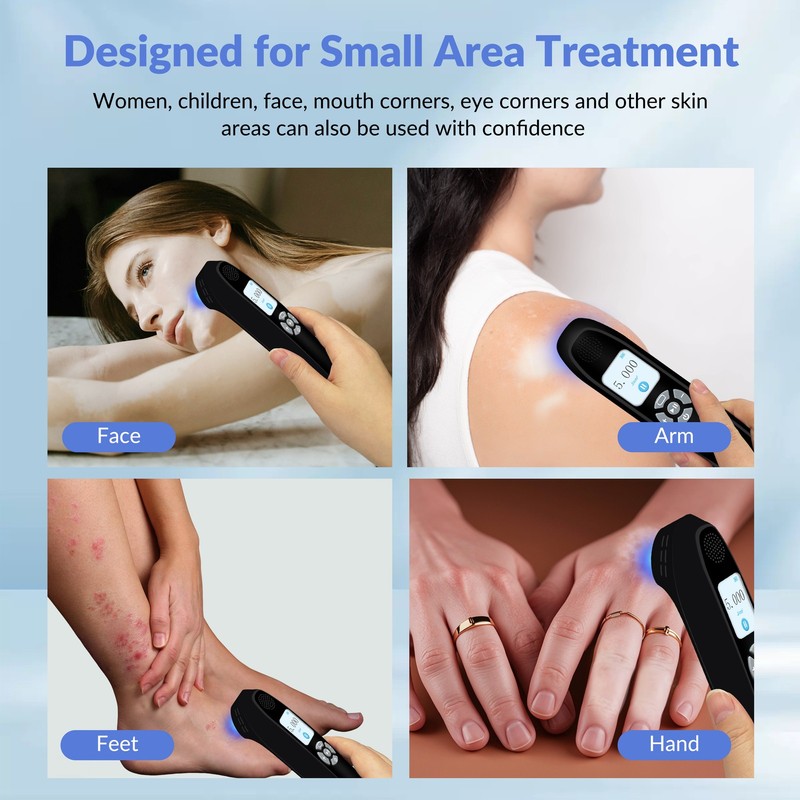 308nm UVB Light Therapy Device Face Hand Body Skin Treatment 9 Diodes 65mW/cm² gallery
