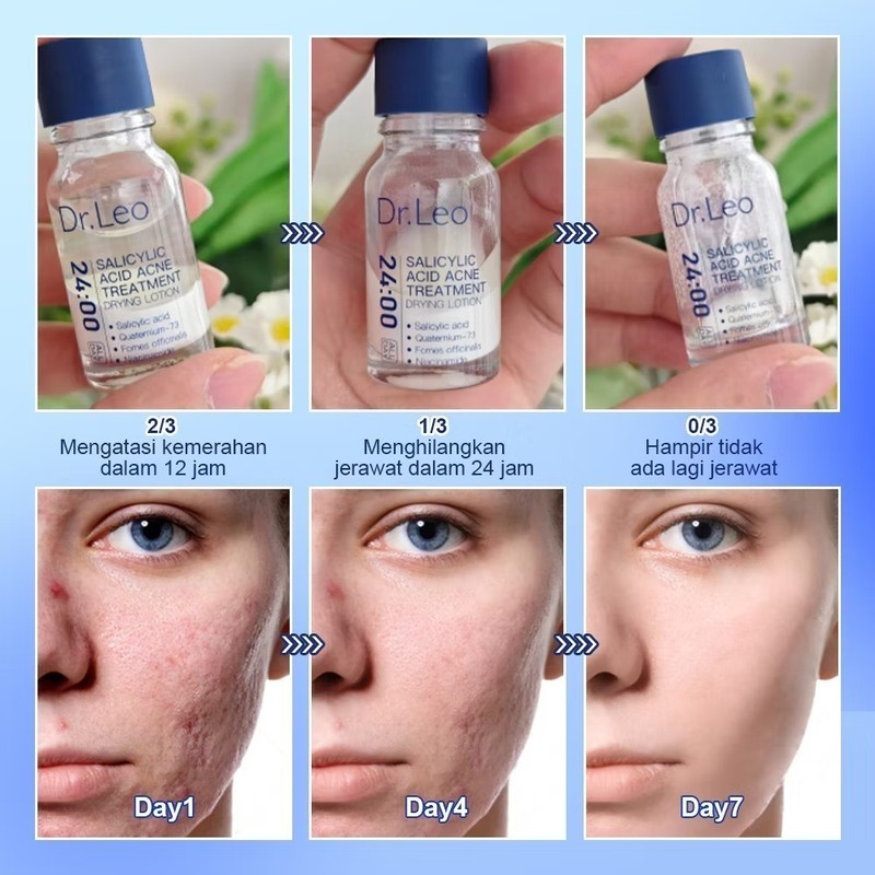 Dr.Leo Acne Essence Salicylic Acid Anti-acne Serum Lighten Acne Scars acne NEW gallery