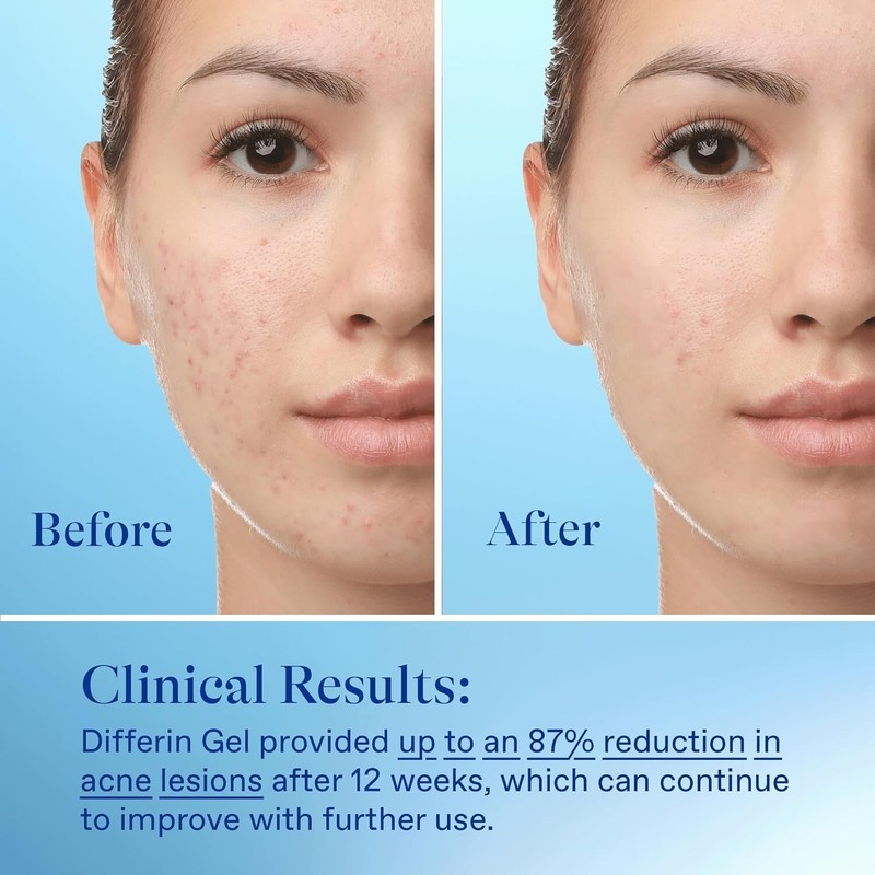Differin Acne Treatment Gel, 30 Day Supply, Retinoid Treatment for Face with 0.1 gallery