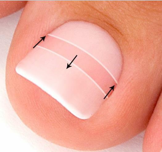 10Pcs Ingrown Toe Foot Nail Correction Sticker Pedicure Tool Toenail Corrector gallery