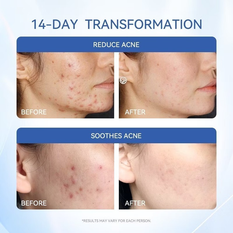 Dr.Leo Acne Essence Salicylic Acid Anti-acne Serum Lighten Acne Scars acne NEW gallery