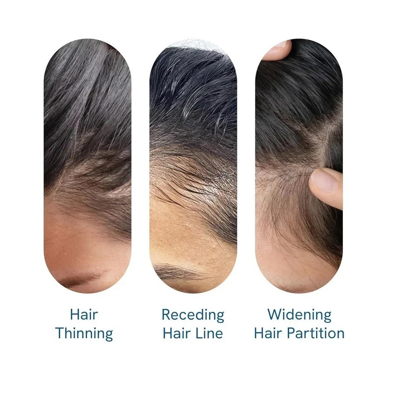 Be Bodywise Hair Growth Serum Roll On - 3% Rosemary, 3% Redensyl & 2% - 25ml gallery
