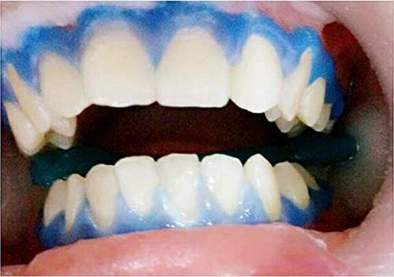 20Pcs Dental Gingival Gel Dam Barrier Gum Protector Syringe Teeth Whitening Gel gallery