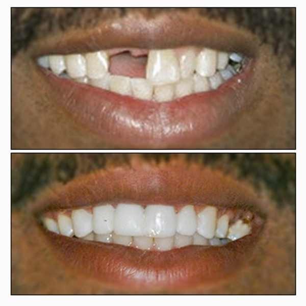 TEMPORARY TEETH TooTH REPAIR KIT * Cosmetic Repair * 30 teeth. IT REALLY WORKS! gallery