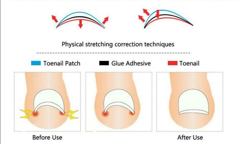 10Pcs Ingrown Toe Foot Nail Correction Sticker Pedicure Tool Toenail Corrector gallery