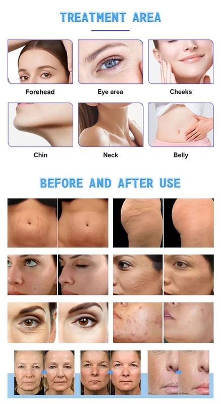 M8 Fractional Gold R-F Skin Tightening Machine Anti Acne Stretch Mark Removal gallery