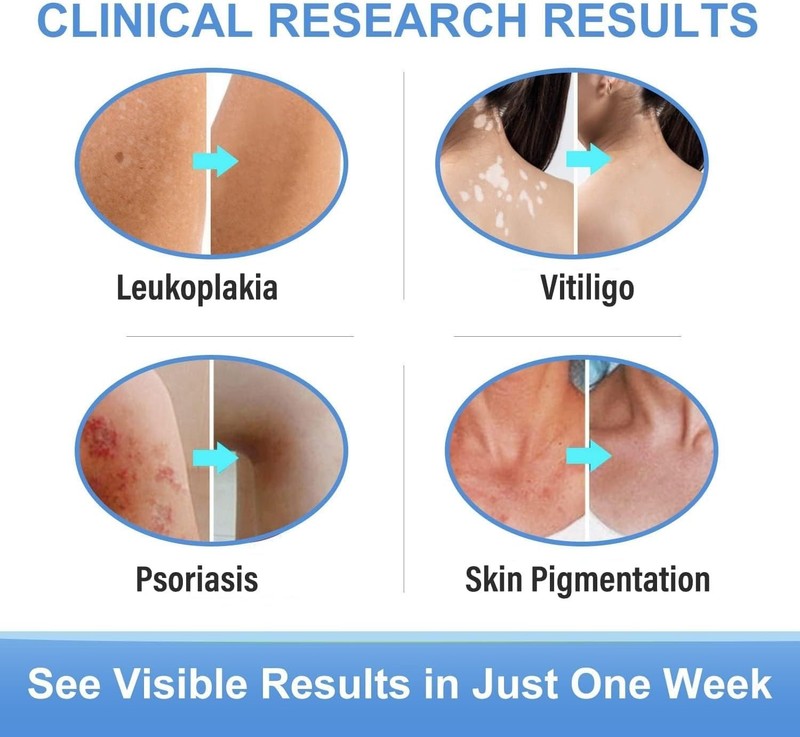 Vitiligo Treatment, Vitiligo Cream Improve Skin Pigmentation & Reduces White ... gallery